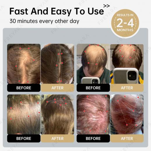 264 LLLT Laser Therapy Cap,Highly Focused Energy, Directly Reaching The Root of The Hair Follicle (5-8mm),Hair Regrowth Device