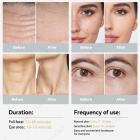 HIFU - FacialDefy 3.0, Professionelles HIFU RF Ultraschallgerät Für HIFU Behandlung & Facelifting, Hautstraffung, Anti-Aging- Und Faltenbehandlung