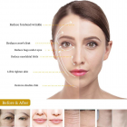 HIFU - FacialDefy 4.0, 7D HIFU Focused Ultrasound Beauty Machine,Deep SMAS Face Lifting,Fat Removal,Wrinkle Removal,Body Shaping