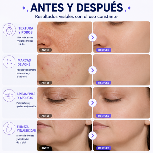 FacialPure Premier Plasma Pen™ - Reafirma, Renueva y Revitaliza Tu Piel Desde Casa, Dispositivo de Rejuvenecimiento Facial 4 en 1