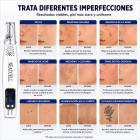 FacialPure Lite™ – Lápiz Láser de Luz Azul para Manchas y Pigmentación, el láser de picosegundos de luz azul para manchas, renovación cutánea y eliminación de melanina.