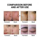 LASER FacialPure LS006, Home-Use Cordless Picosecond Laser Pen, Suitable for Removing Freckles, Erase Tattoos, Dark Spots and Fading Pigmentation