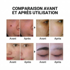 LASER FacialPure LS006 – Stylo laser picoseconde sans fil à domicile, pour atténuer taches, taches pigmentaires et tatouages