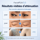 LASER FacialPure 5.0, appareil laser picoseconde compact à technologie noire brillante, élimination indolore et non invasive des tatouages ​​et des sourcils