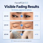 LASER FacialPure 5.0, Brilliant Black Technology Small Suitcase Laser Picosecond Machine, Painless, Non-Invasive Tattoo & Eyebrow Removal