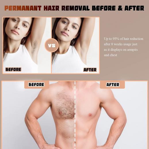 FREYARA IPL Laser Hair Removal Permanent at Home, Ice Painless for Full  Body, 999999 Flashes, 5 Levels, FDA Certified, Plug Charge