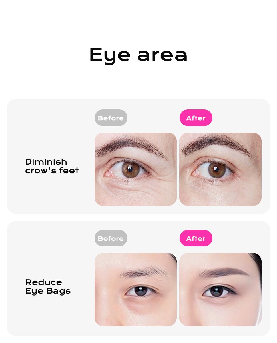 Supplied before-and-after artwork showing two eye-area comparisons