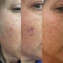 Best at home laser you will find.