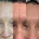 Best at home laser you will find.