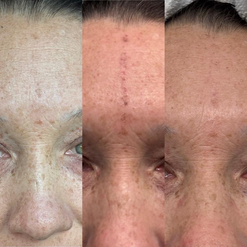 LASER FacialPure Lite, The Blue-Light Picosecond Laser Pen for Spots, Scars , Skin Renewal, Melanin Removal