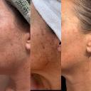 Best at home laser you will find.