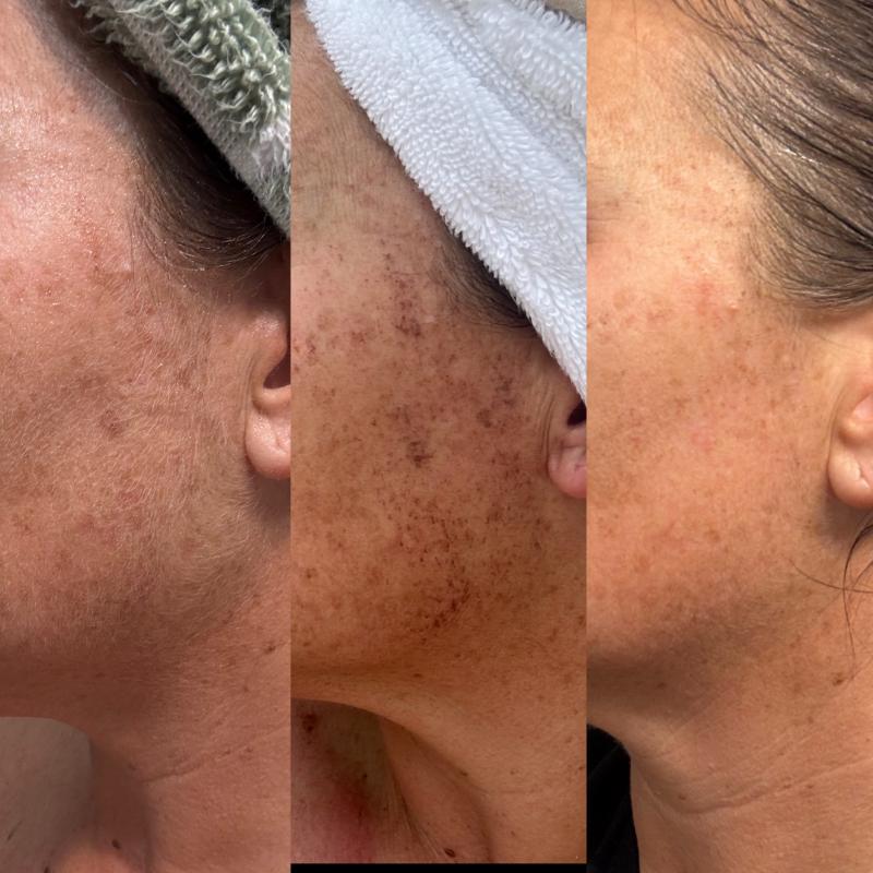 LASER FacialPure Lite, The Blue-Light Picosecond Laser Pen for Spots, Scars , Skin Renewal, Melanin Removal