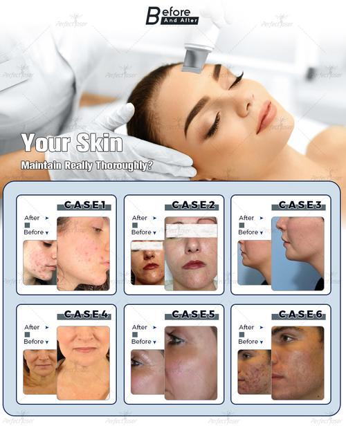 Beauty Machine for Facial Treatment