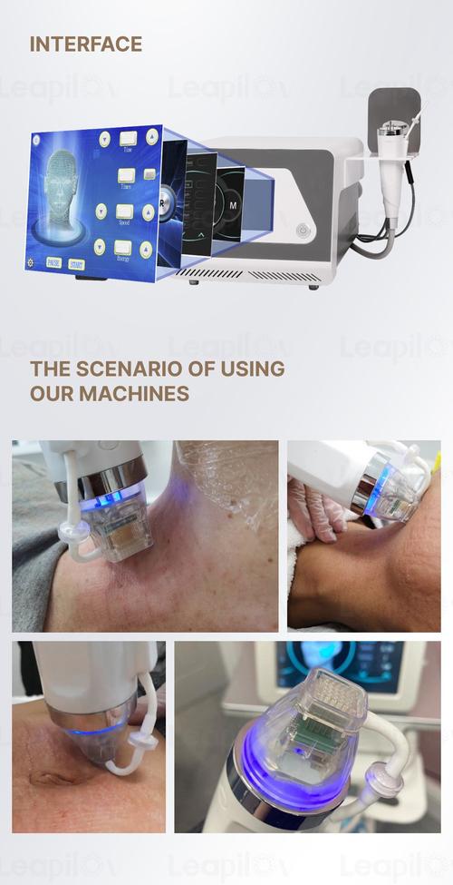Professional microneedling treatment demonstration