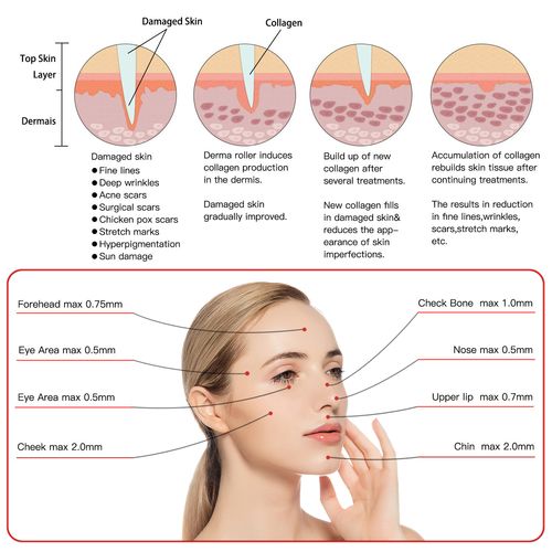 microneedling professional