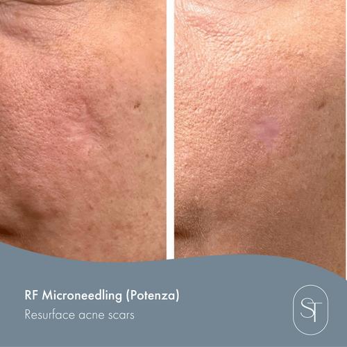 microneedling for acne scars