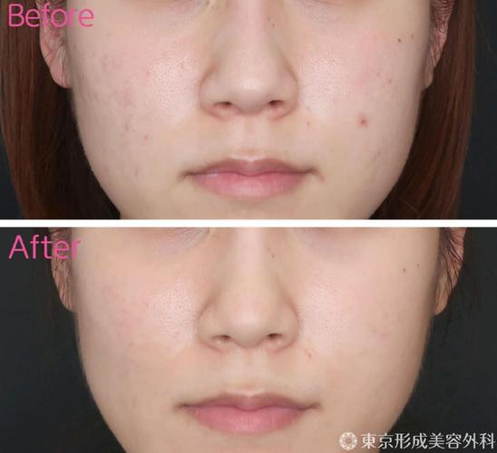 Professional dermapen treatment demonstration on facial skin