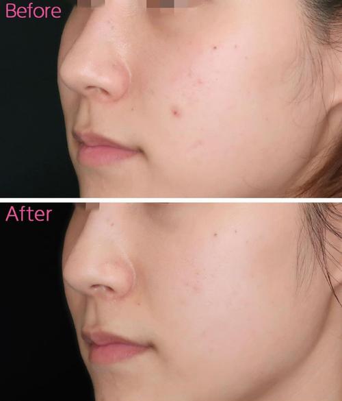 Dermapen manufacturing steps with quality checkpoints