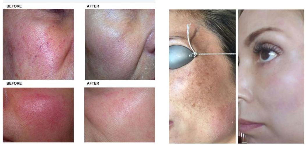 permanent hair removal IPL