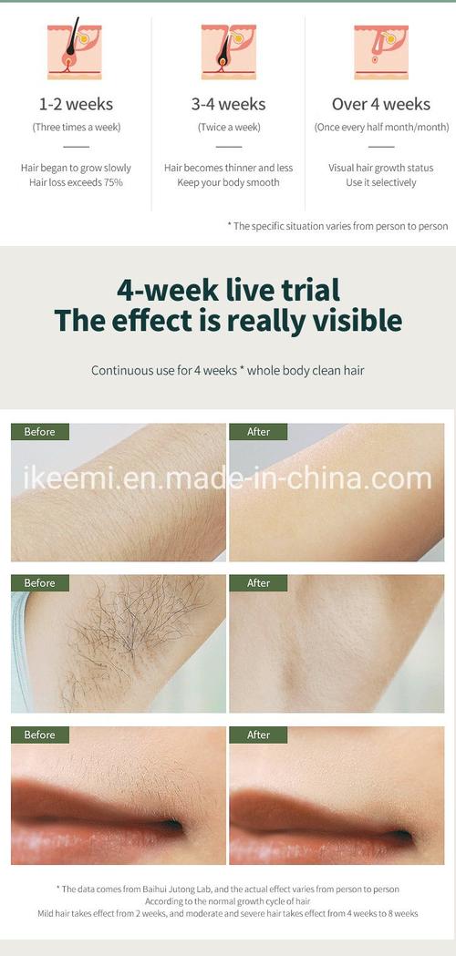 permanent hair removal IPL
