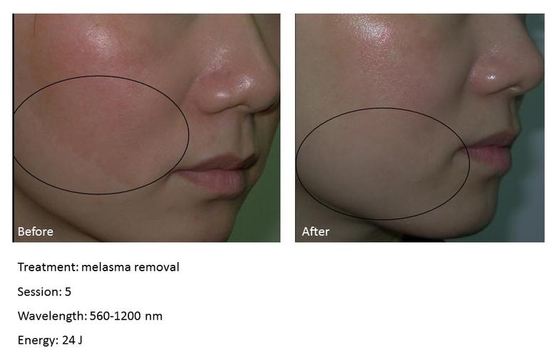 IPL hair removal before and after