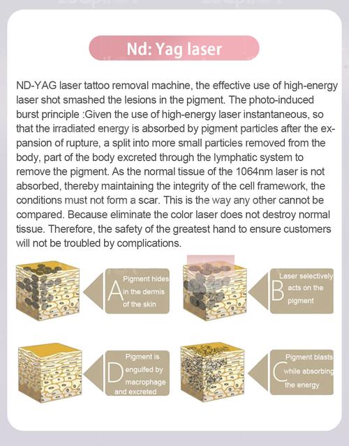 IPL hair removal reviews