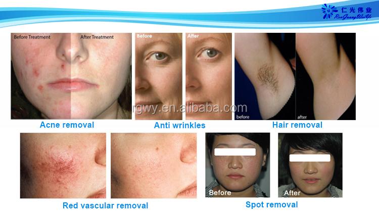 IPL hair removal device demonstration