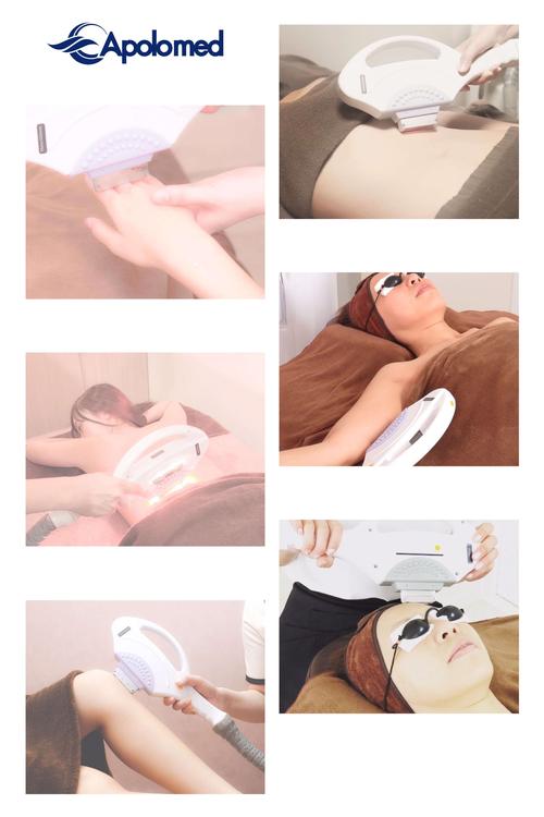 IPL hair removal side effects