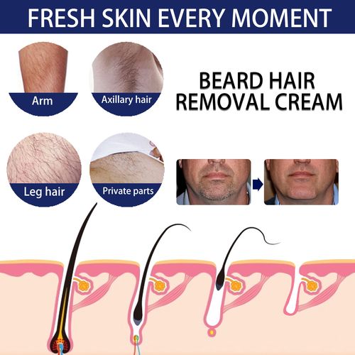 IPL hair removal side effects