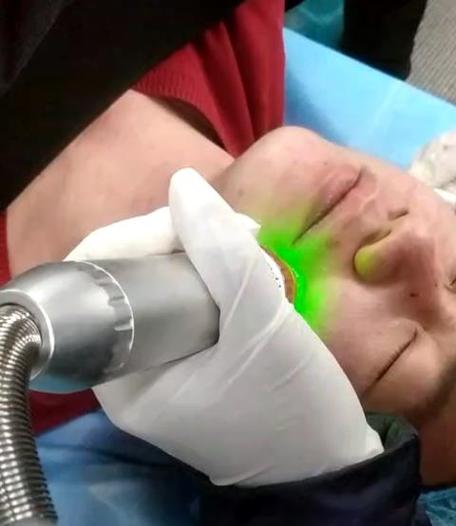 microneedling facial cartridges